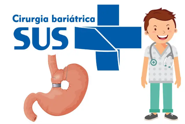 Cirurgia-bariátrica-pelo-SUS-totalmente-de-graça!